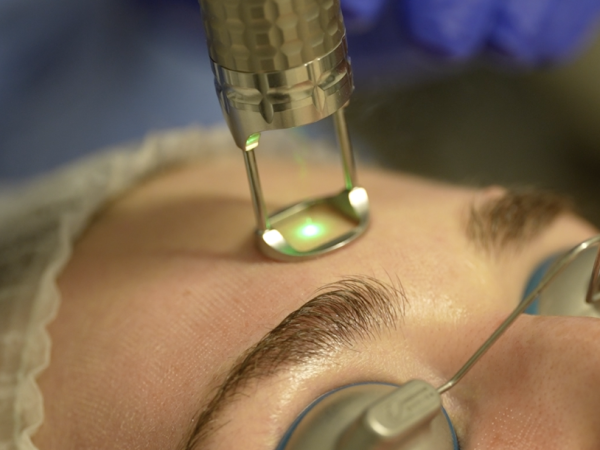 Fractional Resurfacing Laser in NYC