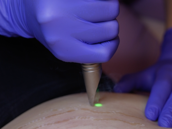 Stretch Marks Removal Laser in NYC