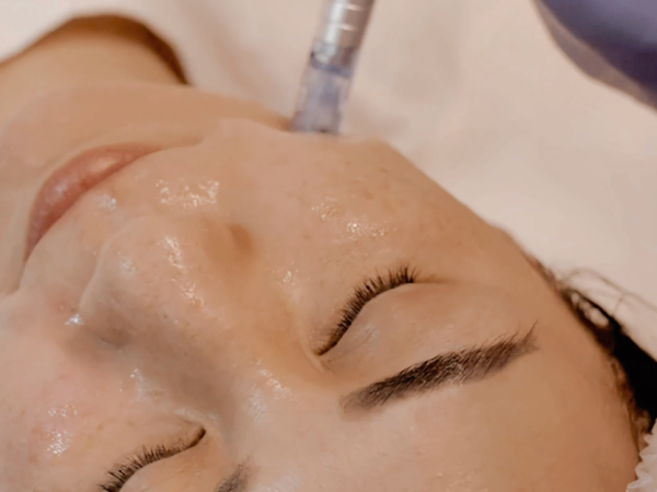 Microneedling Facial in NYC