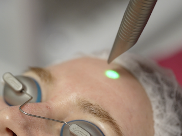 Erbium Laser Resurfacing in NYC